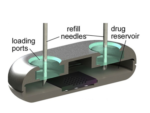 Cross-sectional rendering of NDI depicting drug refill needles through the loading ports with resealable silicon plugs