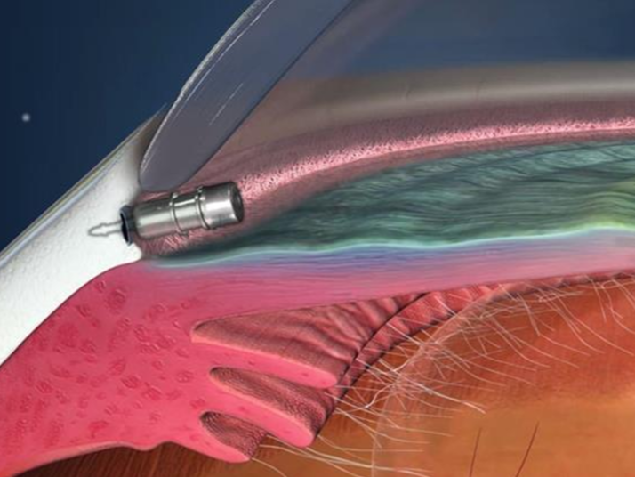 Intracameral VITALDOSE depot of Travoprost